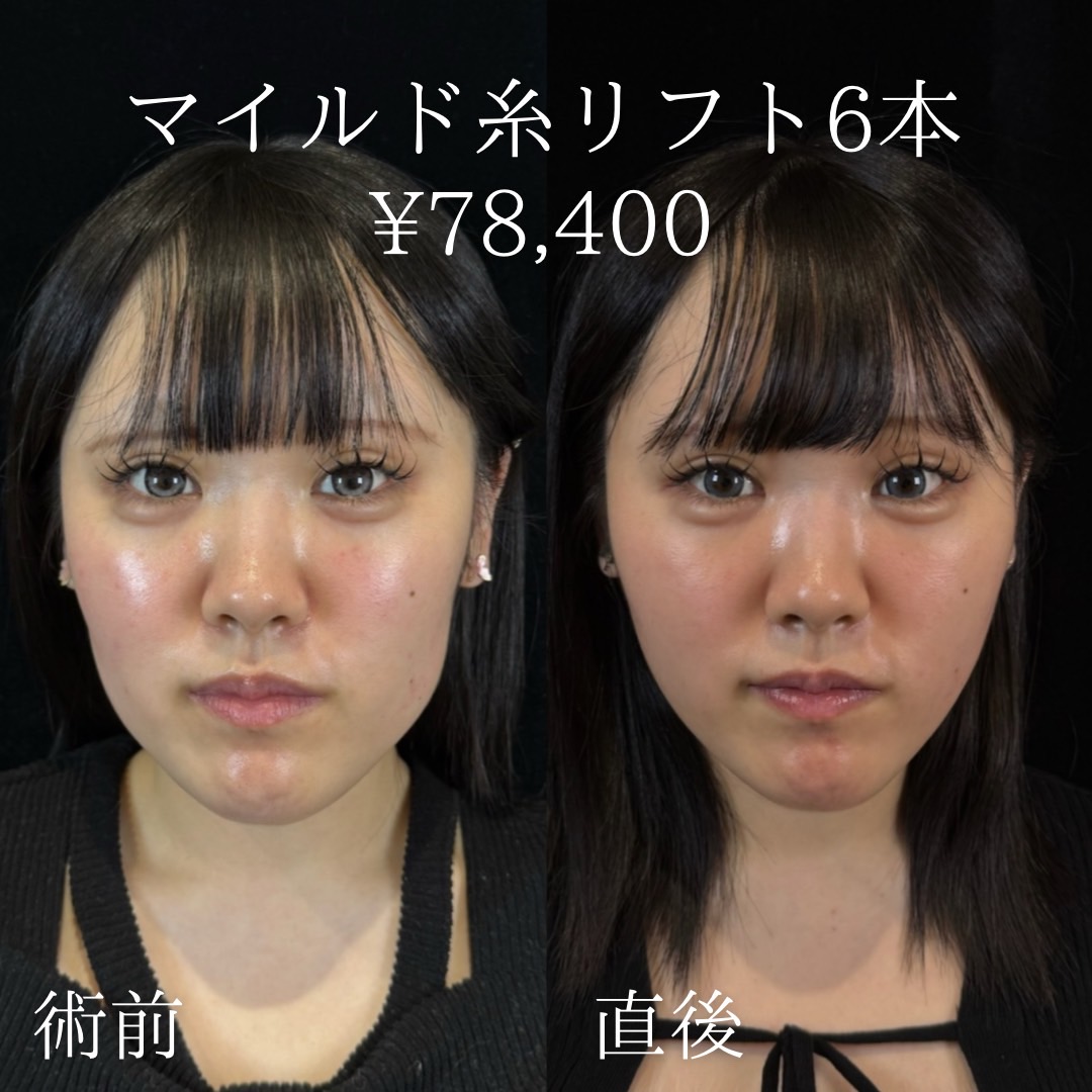 マイルド糸リフト6本