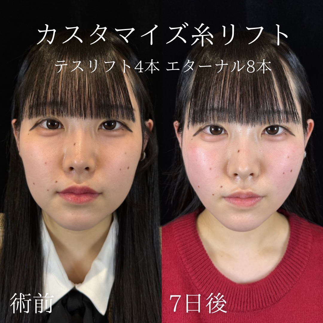 カスタマイズ糸リフト