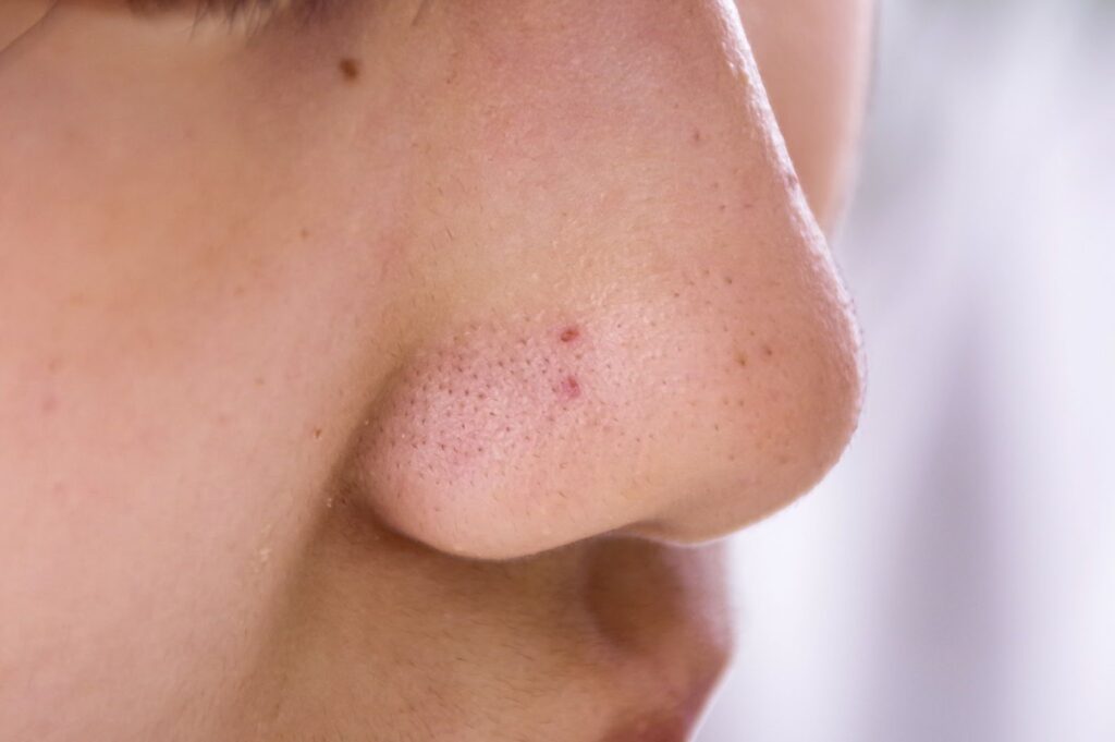 黒ずみ毛穴のある鼻