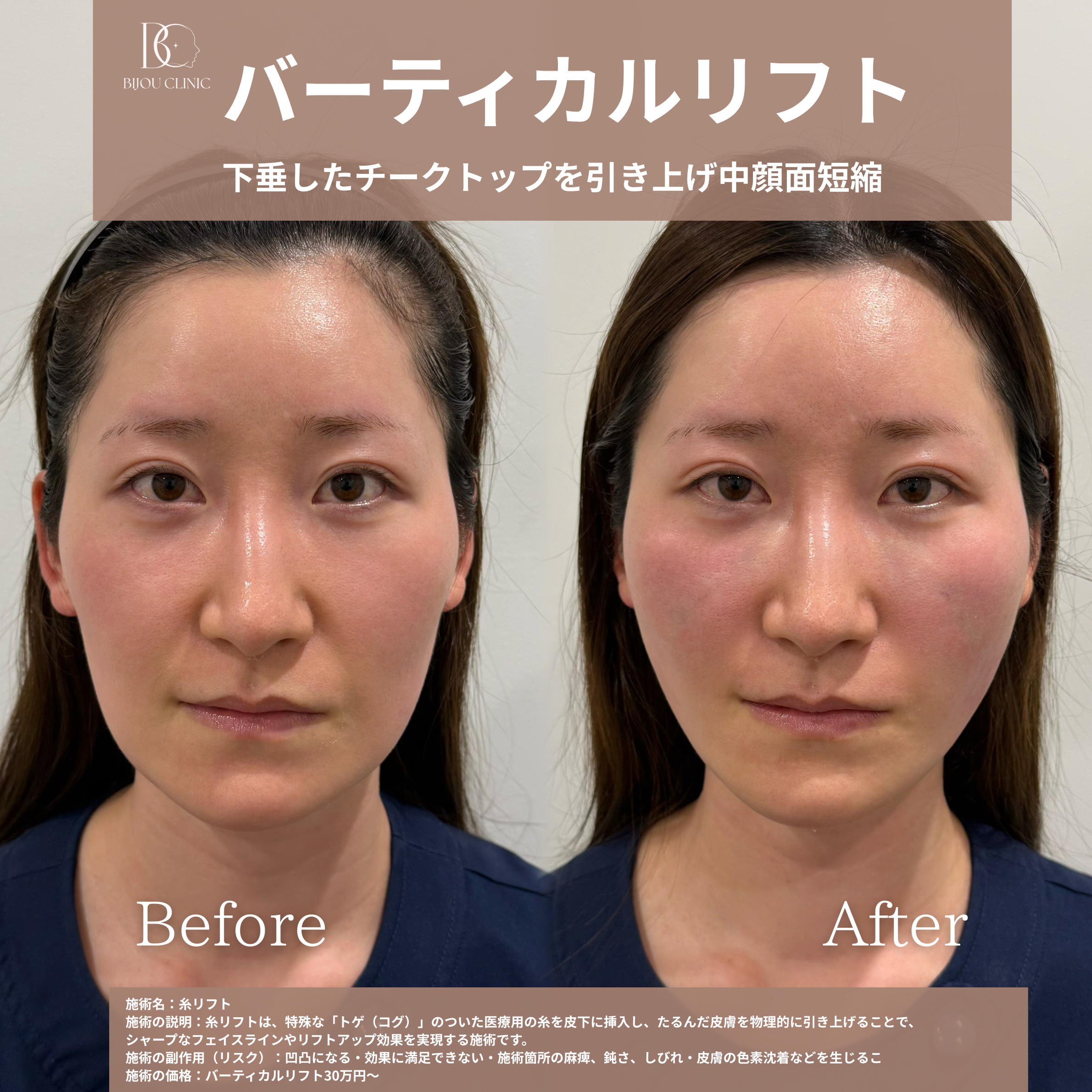 バーティカルリフト