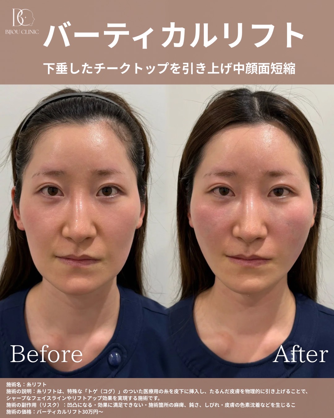 バーティカルリフト