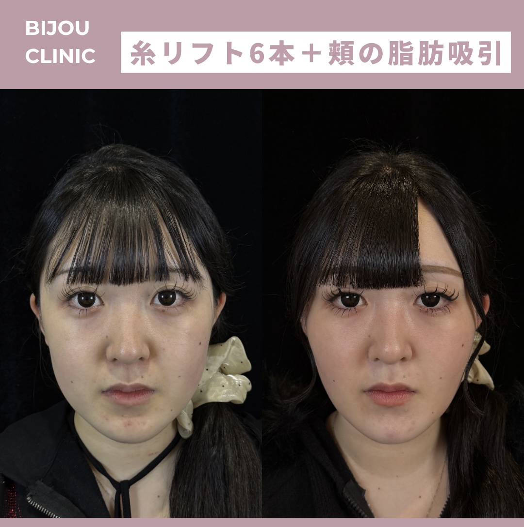 糸リフト6本×頬の脂肪吸引