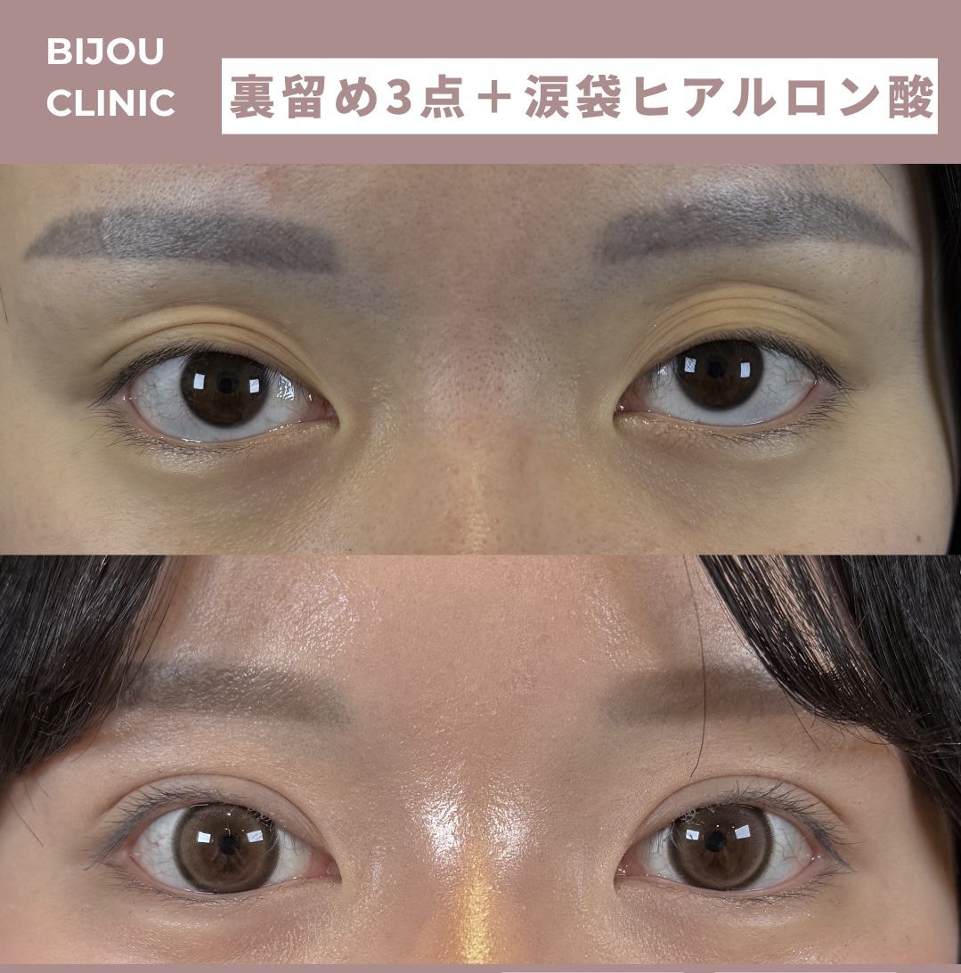 BIJOUプレミアム(埋没法裏留め3点)×涙袋ヒアルロン酸