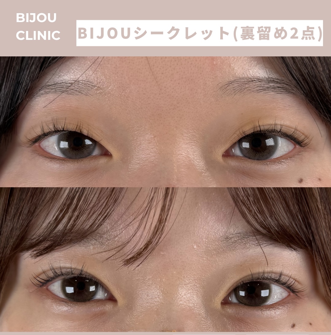 BIJOUシークレット(埋没法裏留め2点)