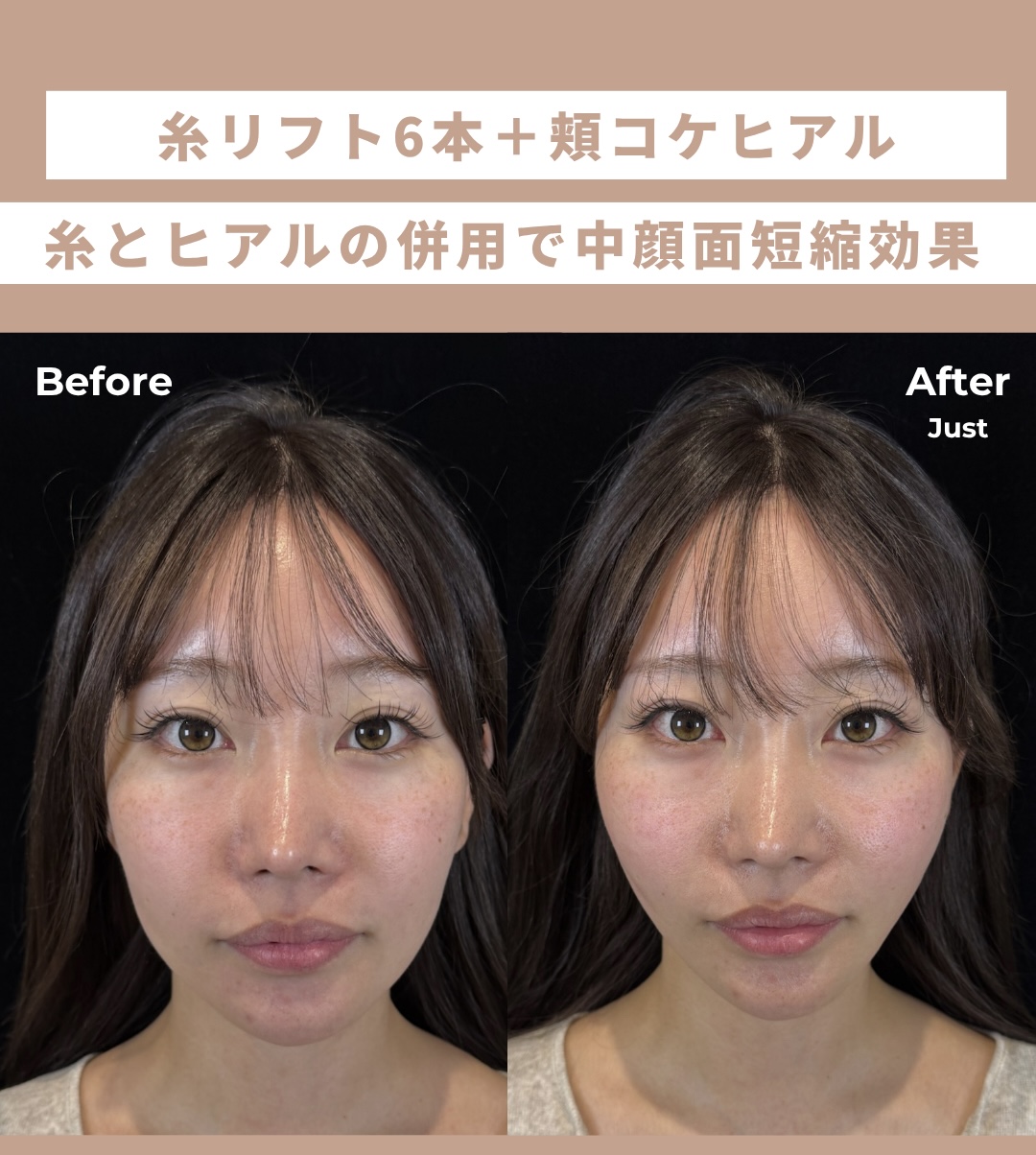 糸リフト6本×頬ヒアルロン酸