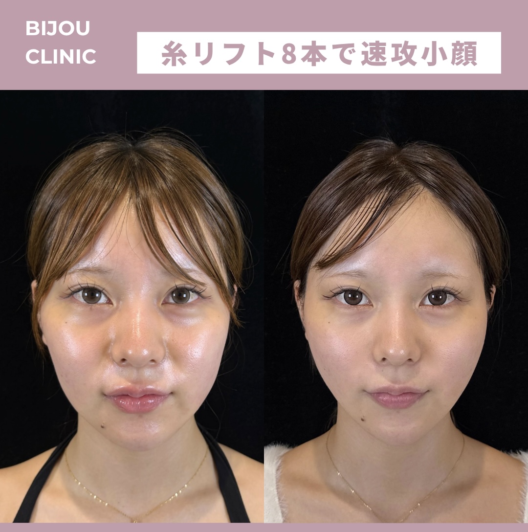 糸リフト8本