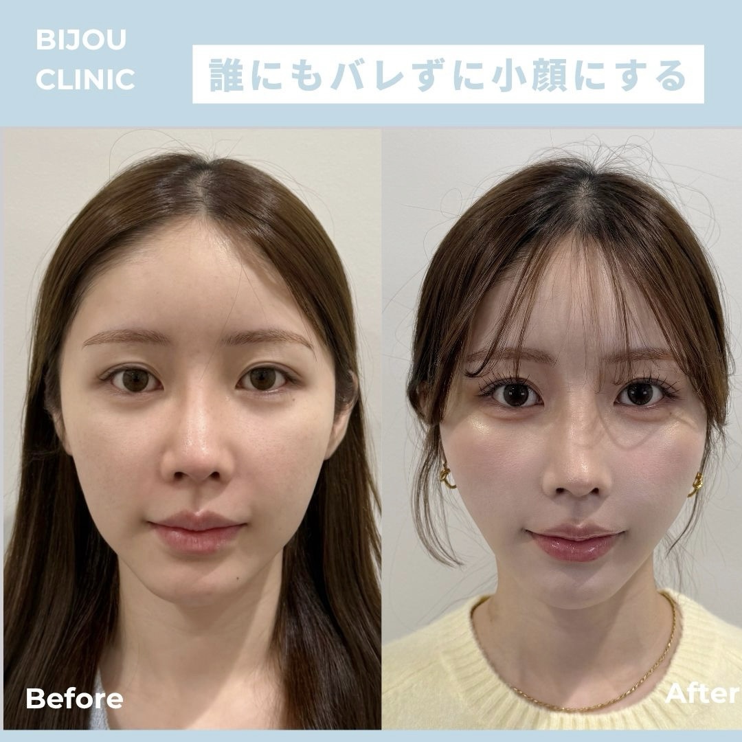 バーティカルリフト8本×糸リフト6本