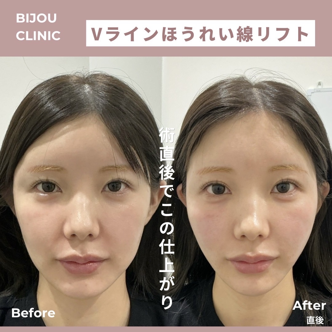 バーティカルリフト6本×糸リフト6本