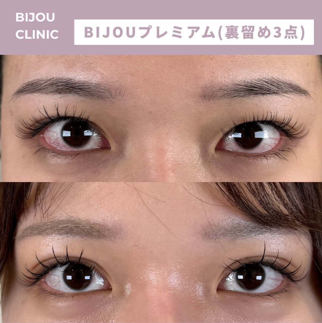 BIJOUプレミアム(埋没法裏留め3点)
