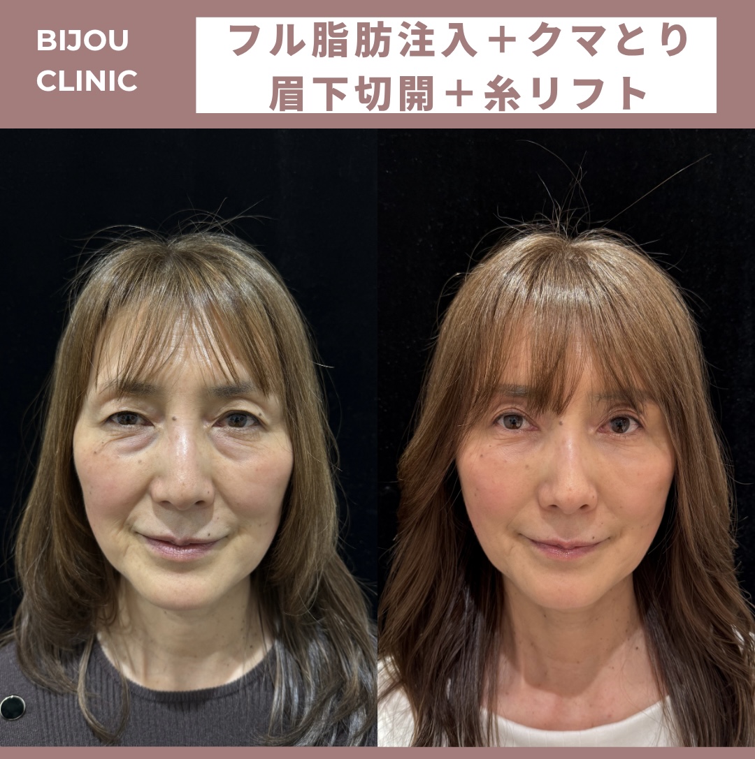BIJOUフル脂肪注入×切らないクマとり×眉下切開×糸リフト14本